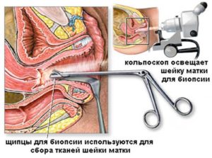 Кольпоскопия. Биопсия