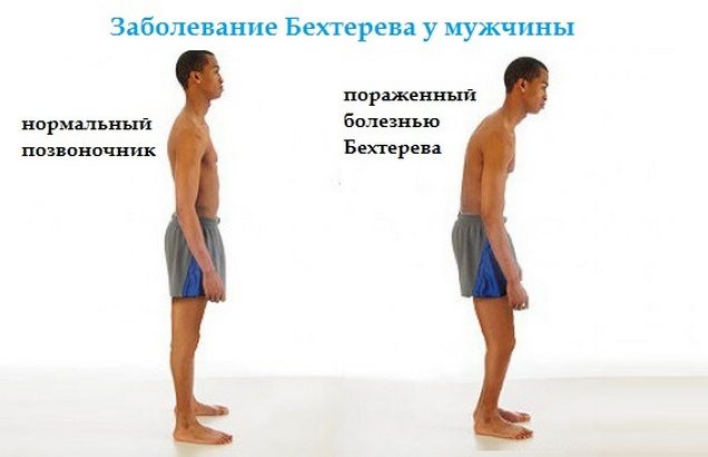 Как выглядит болезнь Бехтерева у мужчин Болезнь Бехтерева у мужчин
