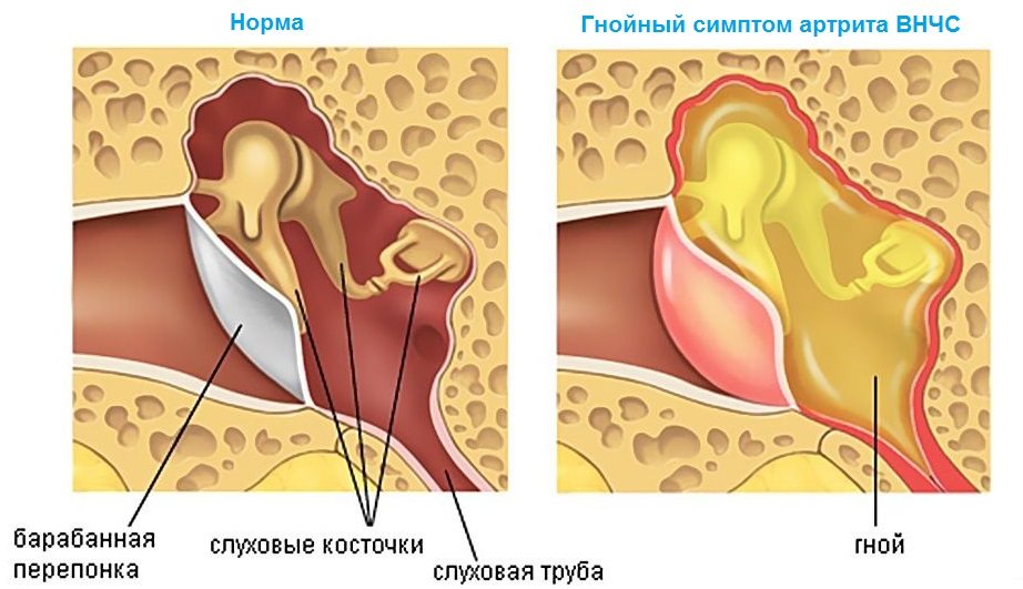 Гнойный артрит ВЧНС Гнойный артрит челюсти