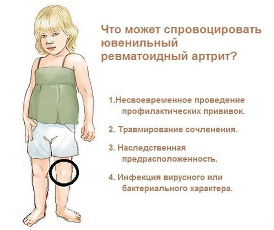 Причины ювенильного артрита у детей Причины ювенильного артрита