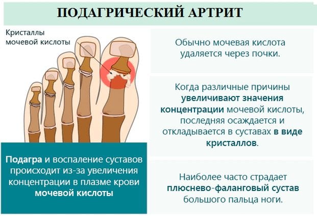 Характеристики подагрического артрита Что такое подагрический артрит