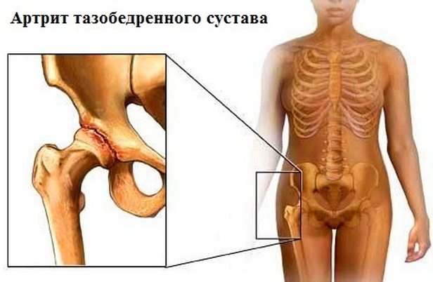 Артрит ТБС Артрит тазобедренного сустава