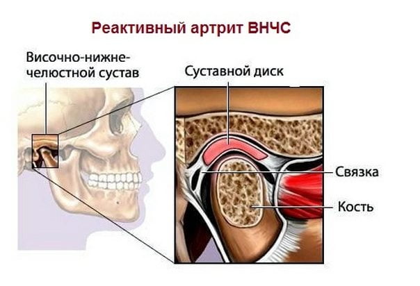 Реактивный артрит ВНЧС Реактивный артрит ВНЧС
