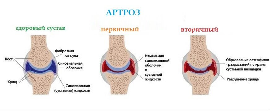 Здоровый сустав, первичный и вторичный артроз Разновидности артроза