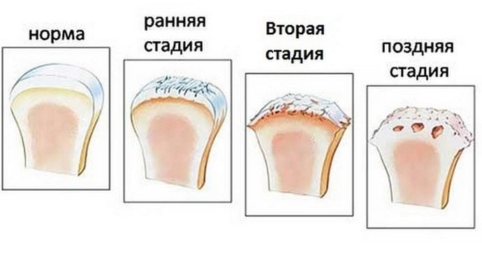 Стадии развития артроза локтевого сустава Стадии развития артроза