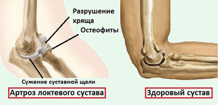 Артроз локтевого сочленения Артроз