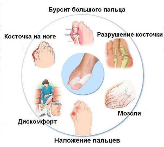 Проявление бурсита большого пальца ноги Бурсит большого пальца ноги
