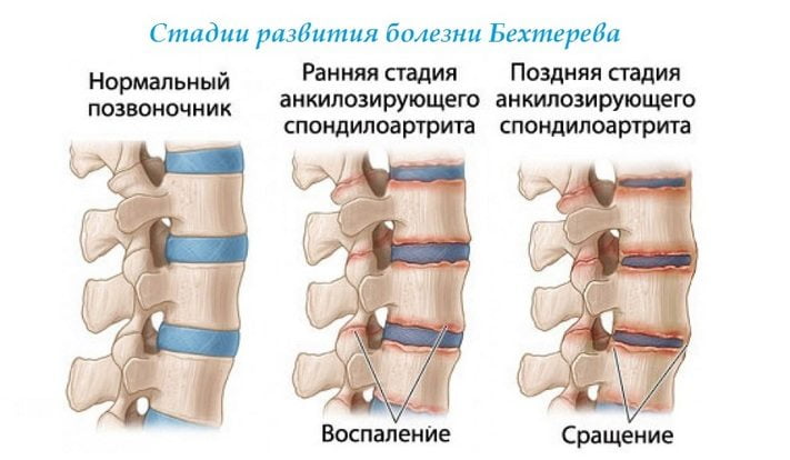 Сравнения нормального позвоночника и развития недуга Стадии развития болезни Бехтерева