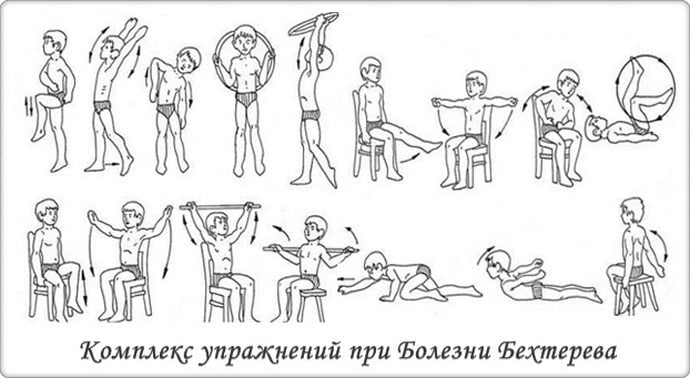 Комплекс ЛФК при болезни Бехтерева ЛФК при болезни Бехтерева