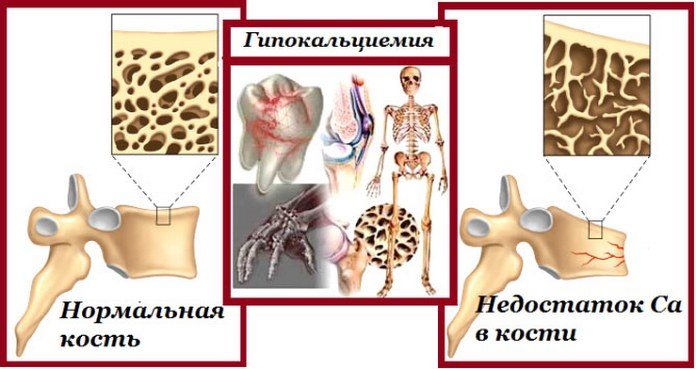 Сравнение нормальной кости и кости при недостатке кальция Недостаток кальция в организме