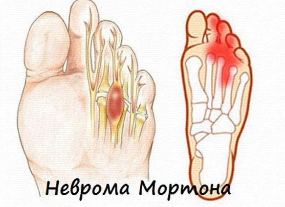 Неврома Мортона на пальцах ноги Неврома Мортона