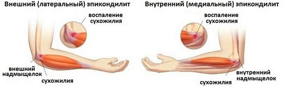 Внешний и внутренний эпикондилит Эпикондилит локтевого сустава
