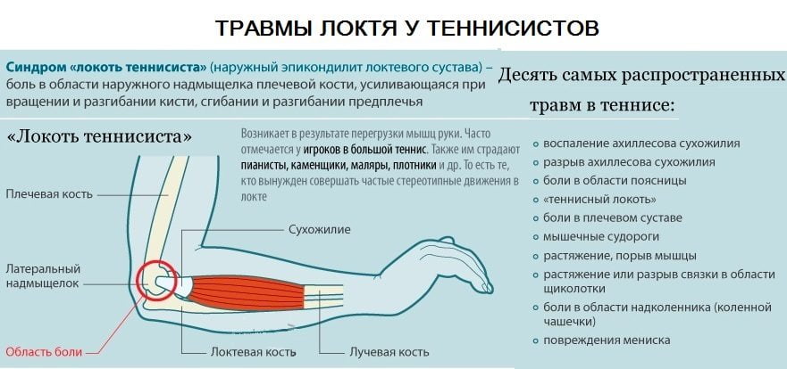 Распространенные травмы локтя у теннисистов Травмы локтя у теннисистов