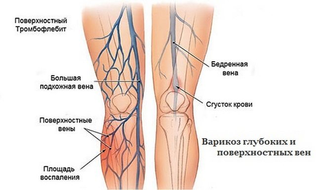 Варикозное расширение вен на ногах Варикозное расширение вен