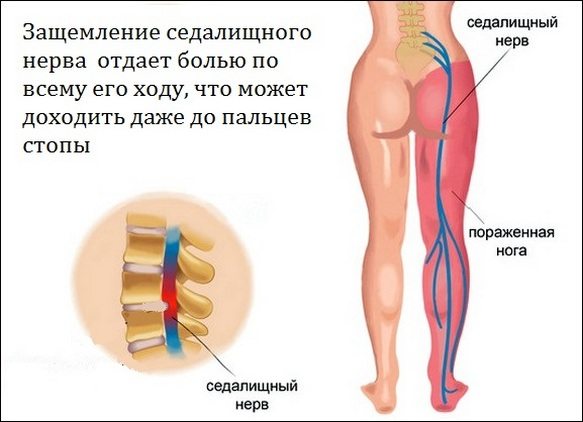 Защемление седалищного нерва Защемление седалищного нерва