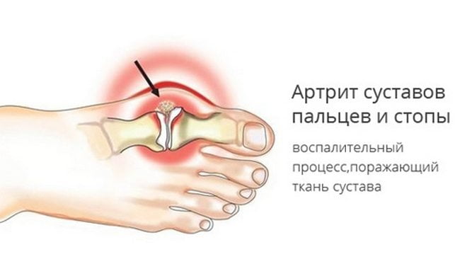 Артрит суставов пальцев ноги Артрит пальцев ноги