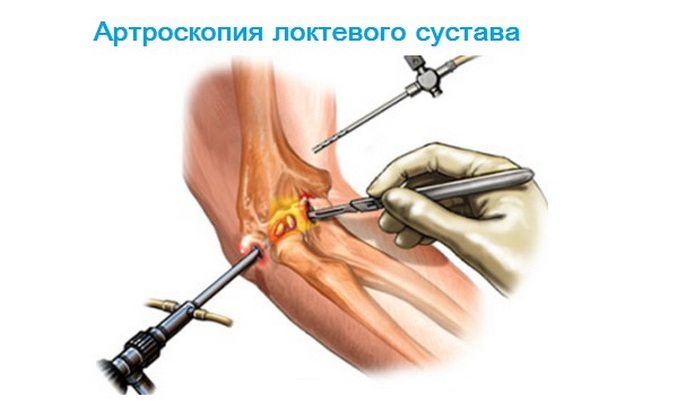 Артроскопия локтя Артроскопия локтевого сустава