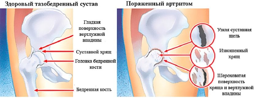 Здоровый сустав и пораженный артритом Пораженный артритом сустав