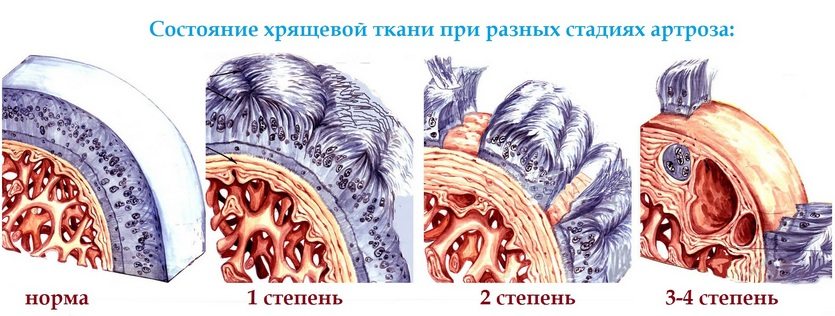 Изменение хрящевой ткани на разных стадиях артроза Изменение хрящевой ткани при артрозе