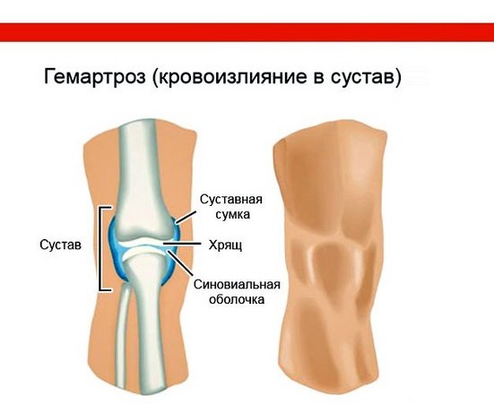 Гемартроз коленного сустава Гемартроз