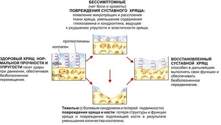 Развитие суставного хряща от здорового к поврежденному и к восстановленному Схема стадий развития повреждений суставного хряща