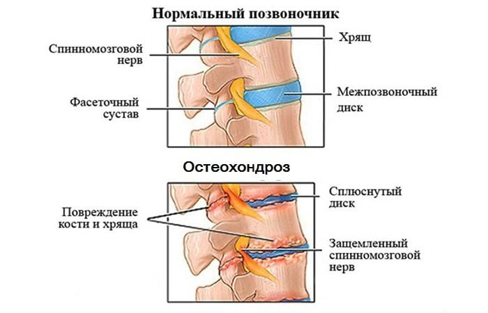 Отличие нормального позвоночника от пораженного остеохондрозом Остеохондроз