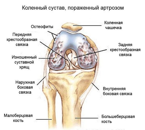 Коленный сустав, пораженный артрозом Артроз коленного сустава
