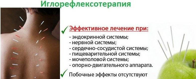 Польза иглорефлексотерапии Иглорефлексотерапия