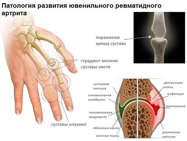 Патология развития ювенильного ревматоидного артрита у детей Патология развития ревматоидного артрита