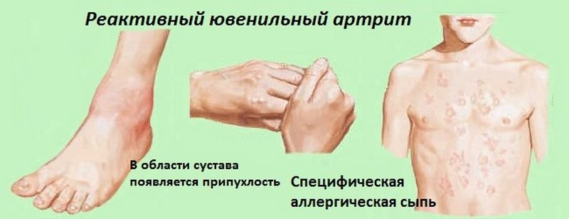 Реактивный ювенильный артрит у подростка Реактивный ювенильный артрит