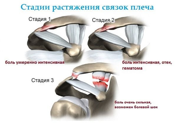 Стадии растяжения связок плеча человека Стадии растяжения связок плеча