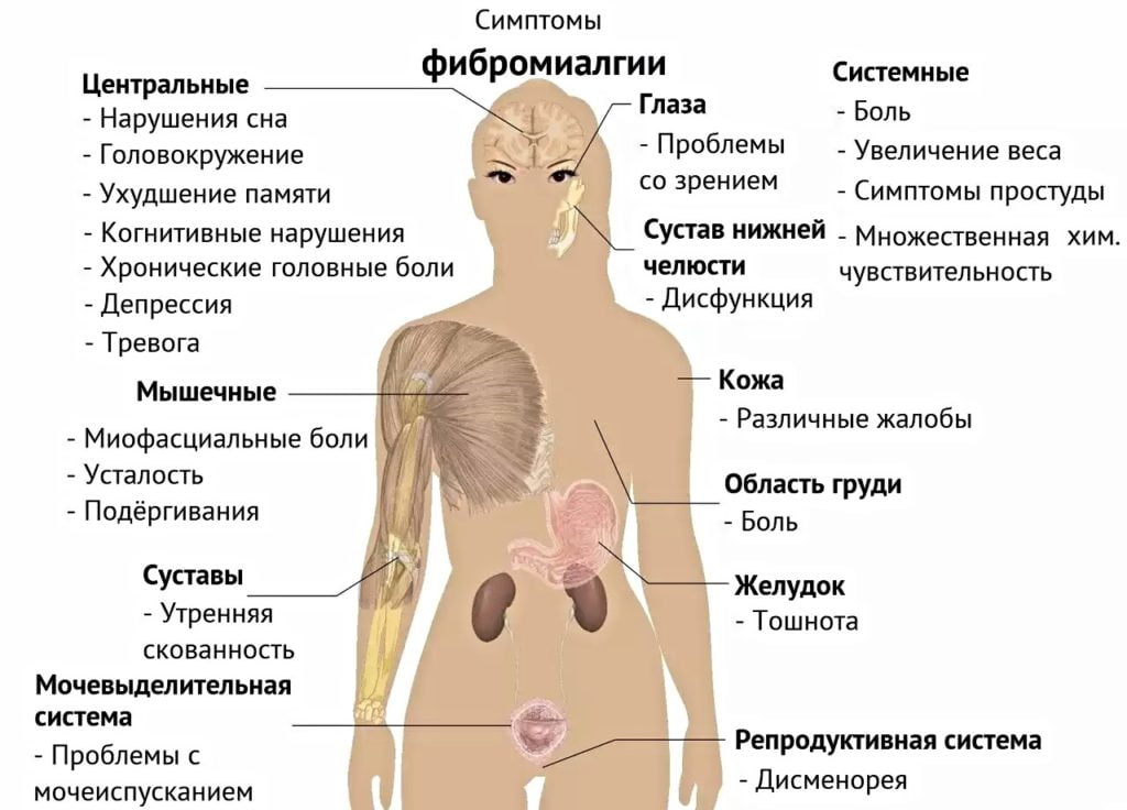 Симптомы фибромиалгии Фибромиалгия