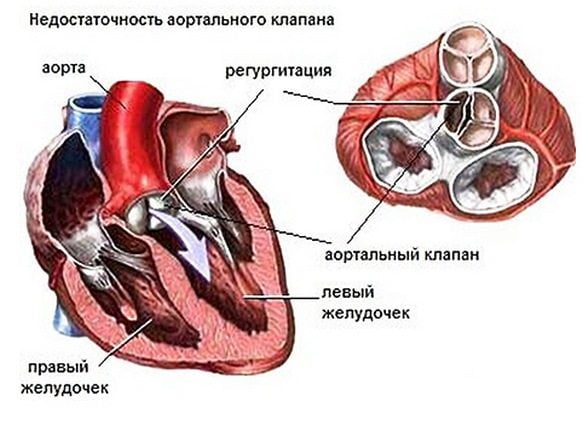 Недостаточность аортального клапана Недостаточность аортального клапана