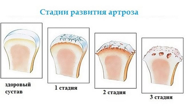Стадии артроза Стадии развития артроза