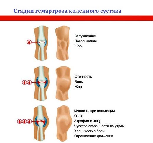 Стадии гемартроза коленного сустава Стадии гемартроза