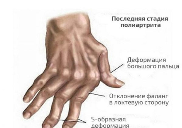 Последняя стадия полиартрита Полиартрит