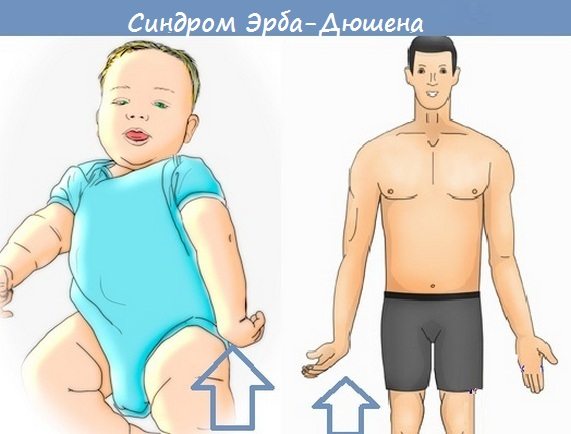 Синдром Эрба-Дюшена у малыша и взрослого человека Синдром Эрба-Дюшена