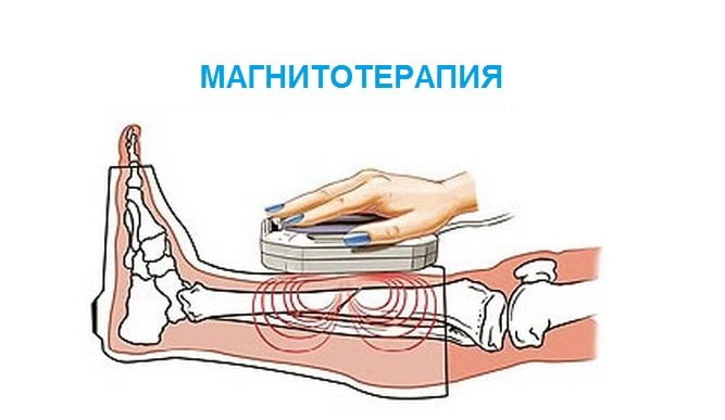 Магнитотерапия для голеностопа Магнитотерапия