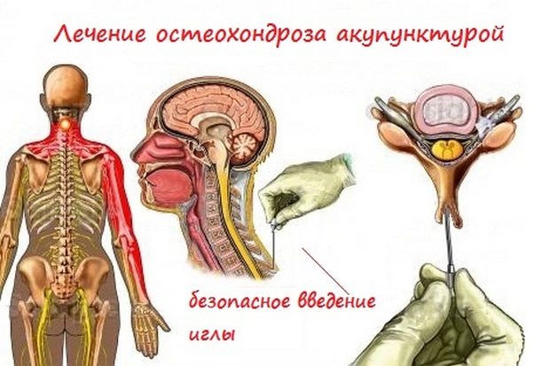 Лечение акупунктурой при шейном остеохондрозе Лечение акупунктурой