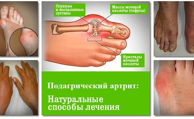 Натуральные способы лечения подагрического артрита Натуральные способы лечения артрита
