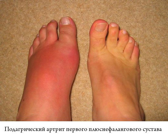 Проявление артрита первого плюснефалангового сустава Артрит плюснефалангового сустава