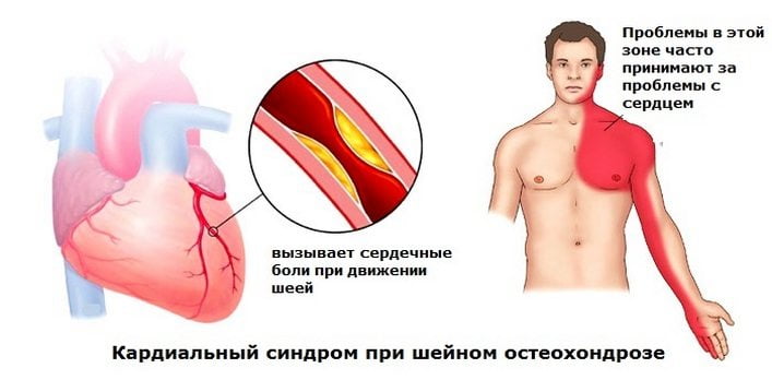 Кардиальный синдром при шейном остеохондрозе Кардиальный синдром