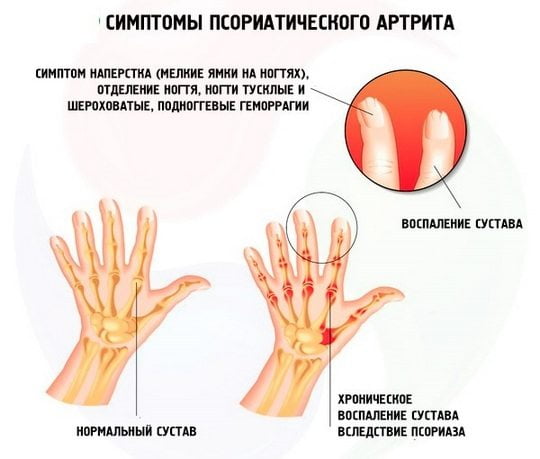 Симптомы псориатического артрита Симптомы псориатического артрита