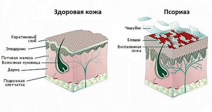 Как влияет псориаз на кожу человека Псориаз
