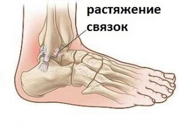 Растяжение связок стопы у человека Растяжение связок стопы