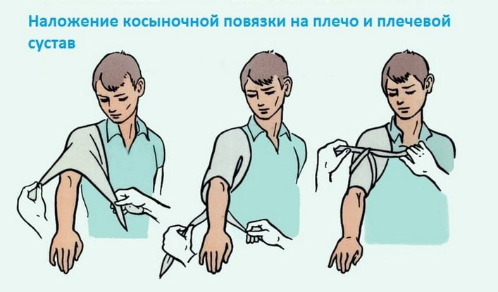 Наложение косыночной повязки на плечо Наложение косыночной повязки
