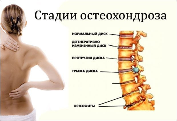 Стадии остеохондроза Стадии остеохондроза