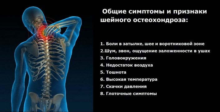 Основные симптомы и признаки шейного остеохондроза Симптомы шейного остеохондроза