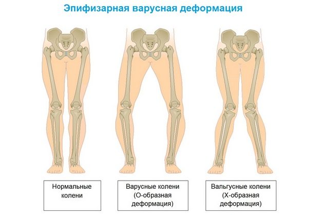 Виды эпифизарной варусной деформации Эпифизарная варусная деформация