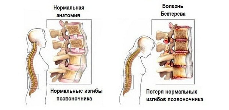 Сравнение нормального позвоночника и пораженного болезнью Бехтерева Болезнь Бехтерева